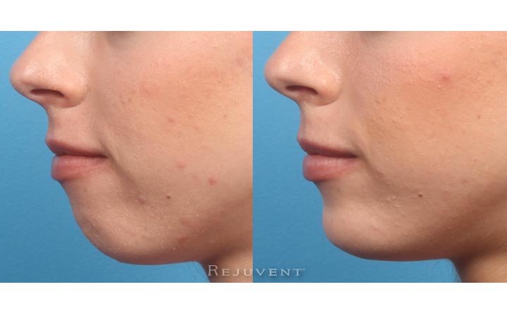 Filler injections chin non surgical chin augmentation