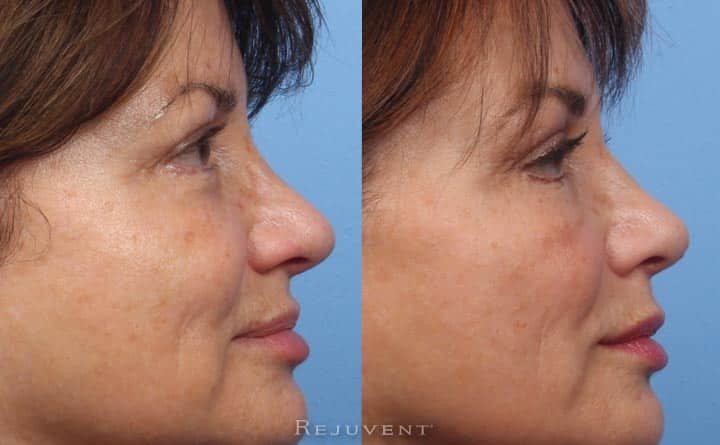 Beautiful results with Non-Surgical nose filler