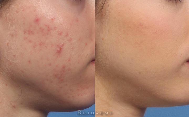 Acne and acne scars can be treated