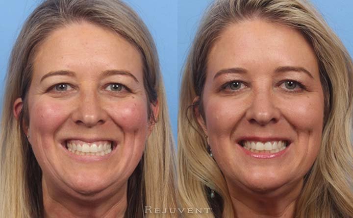 Before and after Botox for gummy smile
