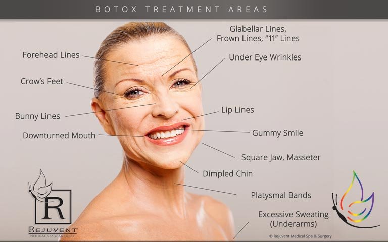 What are the Botox Treatment Areas