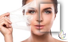 WHy are chemical peels essential to beautiful skin