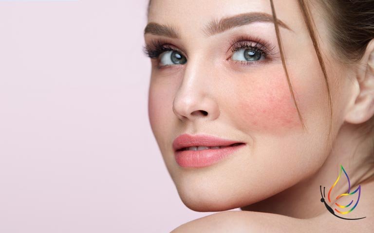 What to do for Rosacea