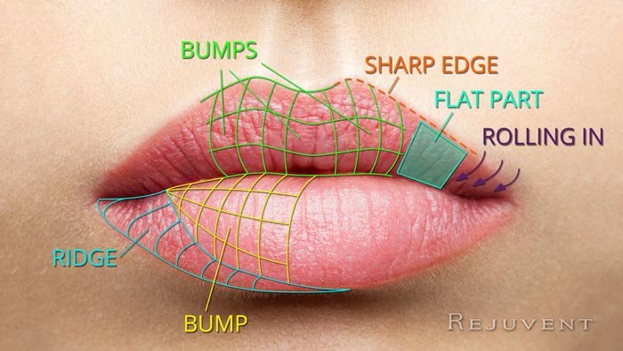 Areas for Lip filler