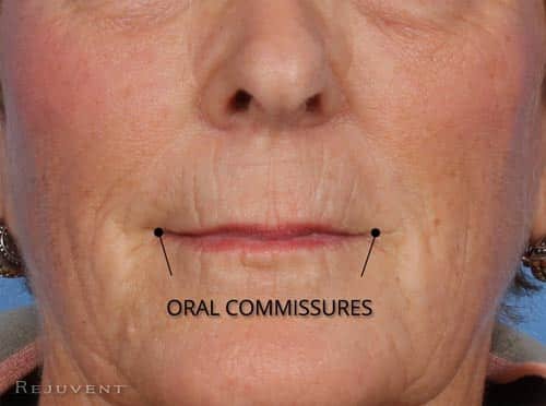 Oral Commissures changes with aging