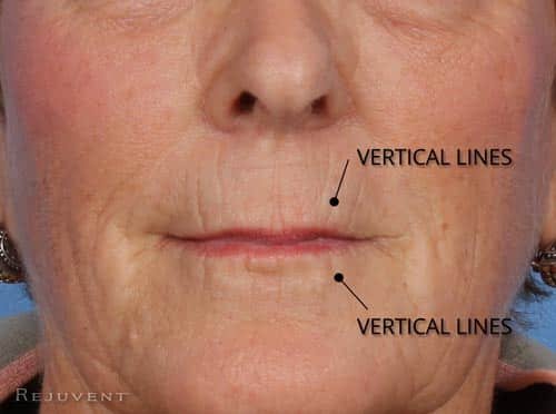 Vertical Lip Lines with Aging