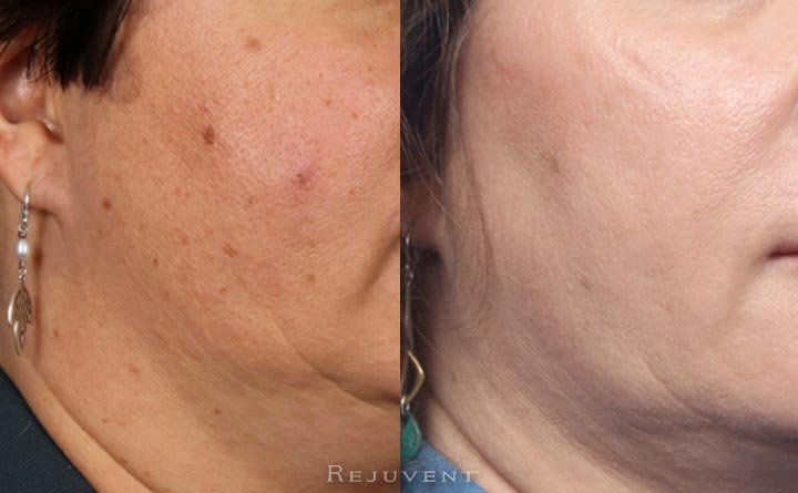Radiant aging skin after skin treatments