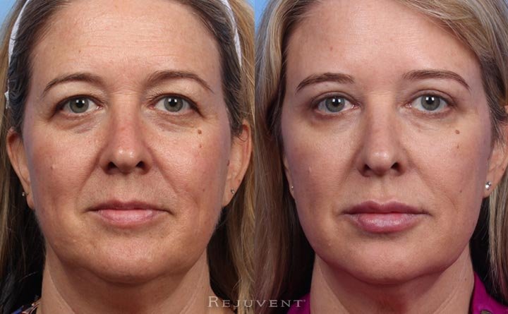 Before and after image Upper eyelid surgery and Non-surgical face lift