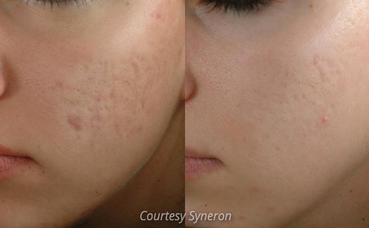 Reduce acne scars with eMatrix Fractional Resurfacing with RF