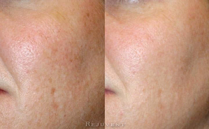 Large pores and pigmentation