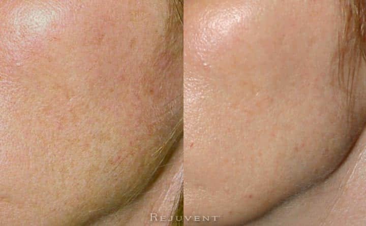 Great Chemical Peel Results