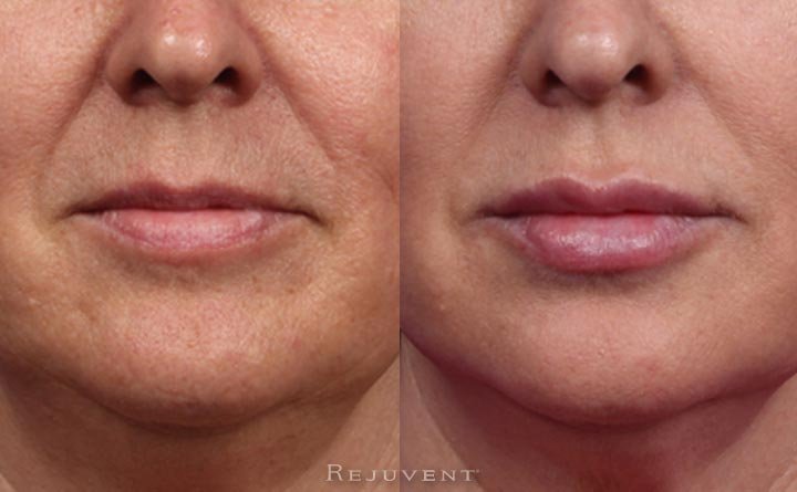 Lip closeup after Lip Augmentation with fillers