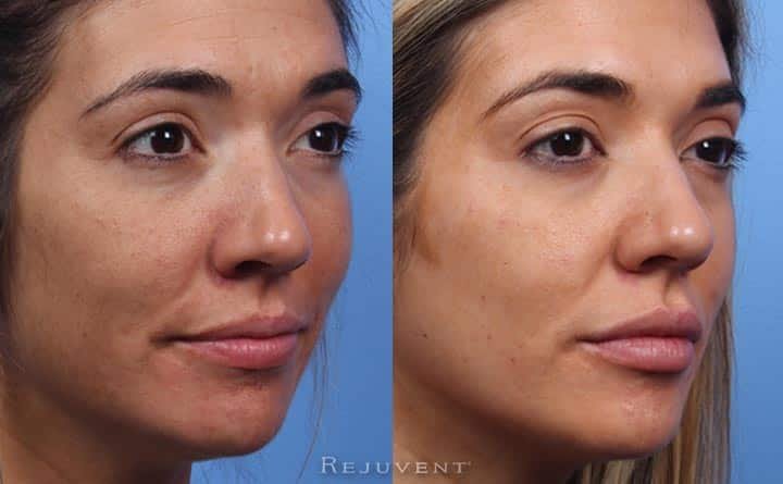 Before and after lip fillers at Rejuvent Scottsdale