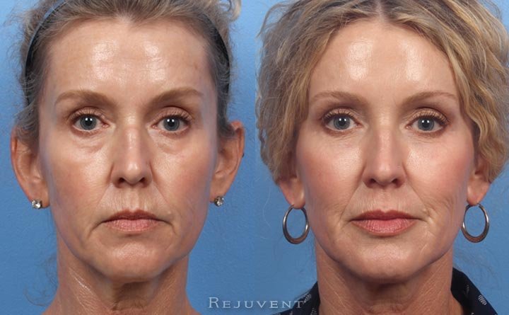 Liquid Facelift before and after natural filler results transformation