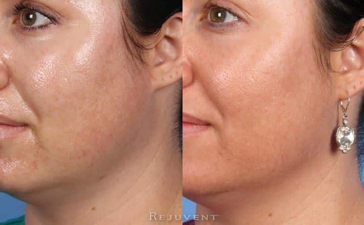 oily skin improvement before and after image