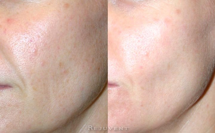 OIly Skin with large pores improvement