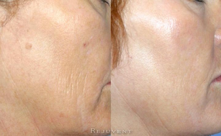 Skin treatment for less wrinkles on aging skin