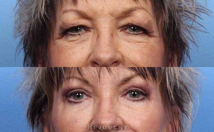 Upper Blepharoplasty Before and after photo