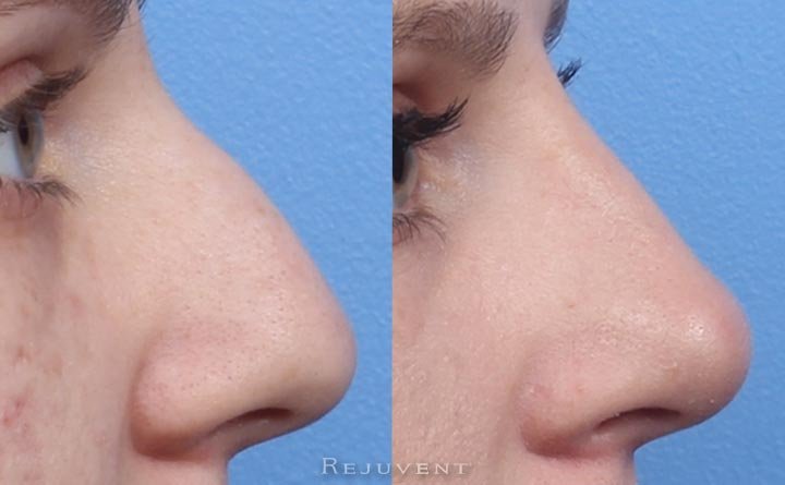 Liquid Rhinoplasty before and after image