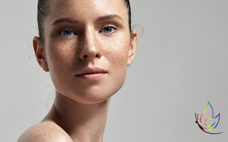 Image of model with hyperpigmentation and freckles