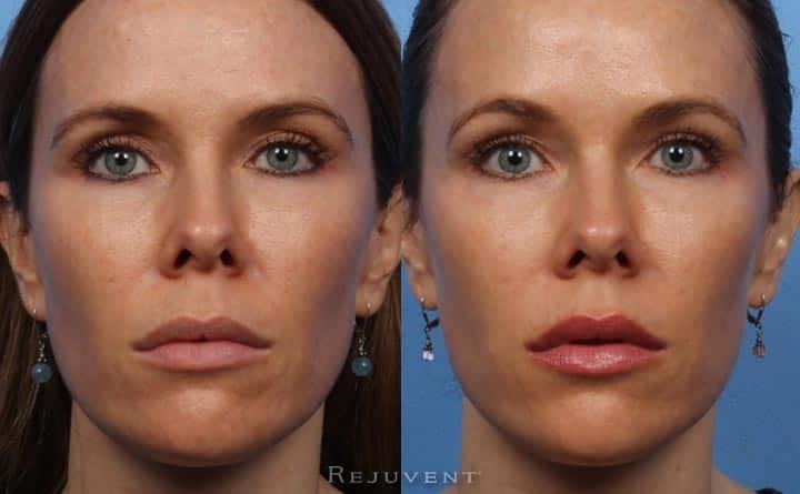 Beautiful Botox Before and After