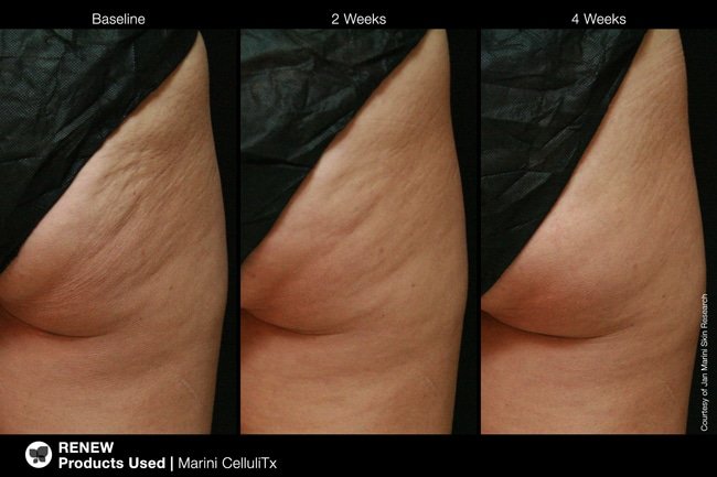 Before and after cellulite skin care treatment