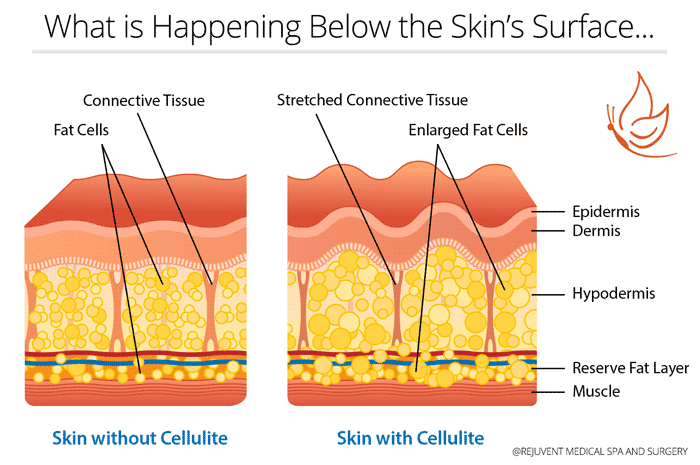 Skin diagram with and without cellulite