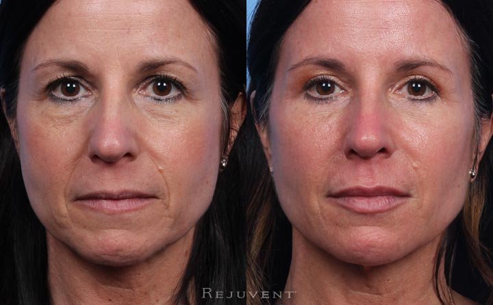 Before and after lower face rejuvenation with fillers