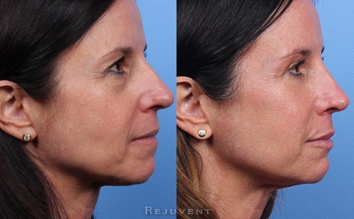 Side view before and after Blepharoplasty