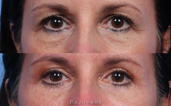Before and after eyelid surgeries