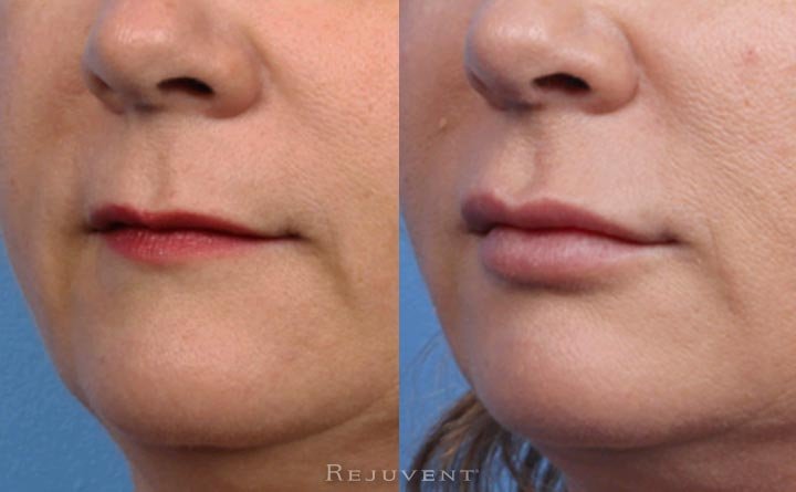 Before and after profile view of lip fillers
