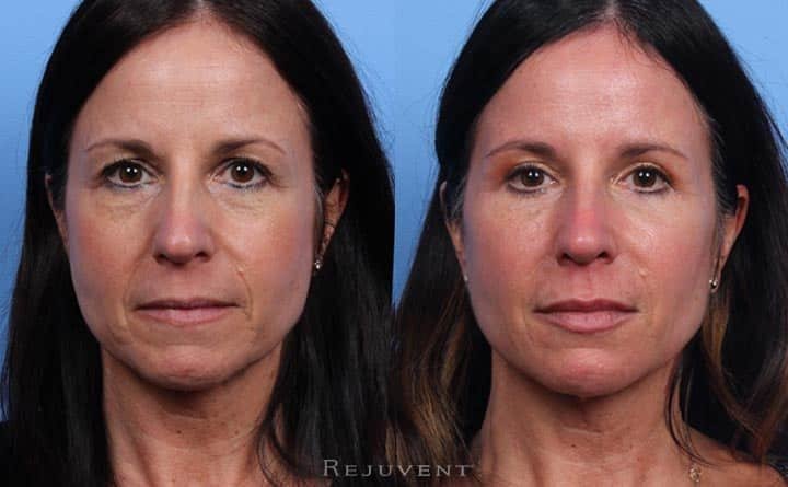 Before and after photo of a Liquid Facelift