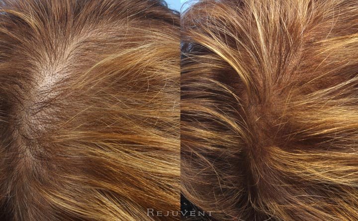 More hair after PRP treatment