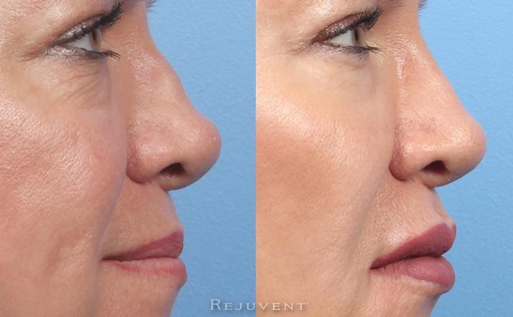 Before and after Non- Surgical Nose filler nose closeup