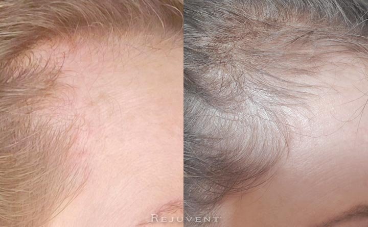 hair growth before and after image