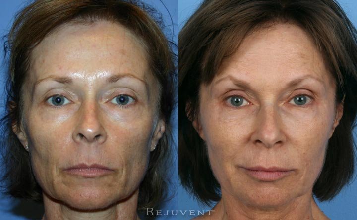 Long-term before and after liquid facelift rejuvenation