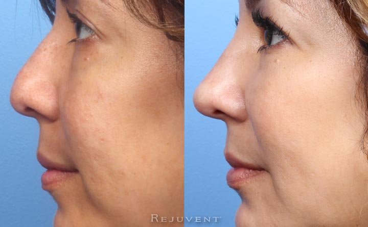 Patient before and after Liquid Rhinoplasty with filler before and after