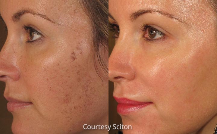 Dark spots gone before and after