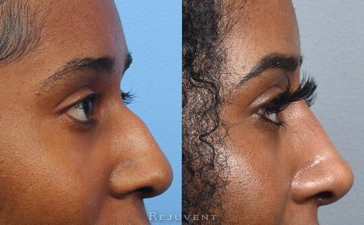 Non Surgical nose filler and nasal sculpting before and after results