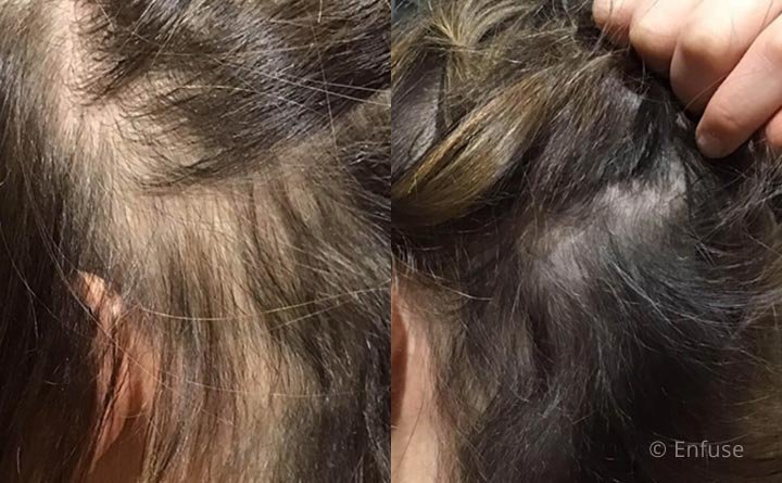 Before and after image of PRF for hair loss treatment