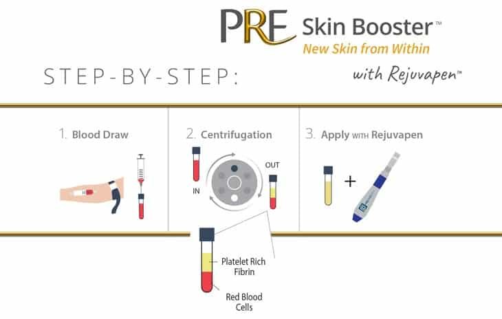 PRF Step by Step for PRF Treatment