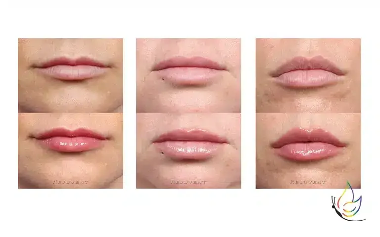 Before and after results of Lip Enhancer for lip volume