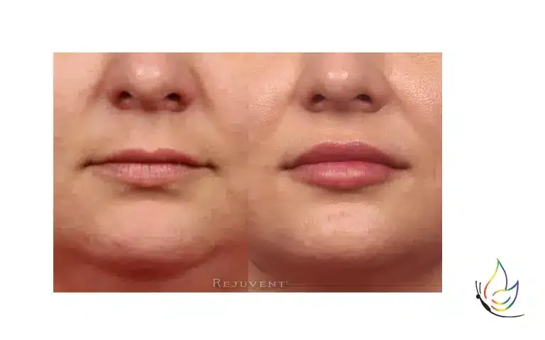 Before and after results with lip filler for volume
