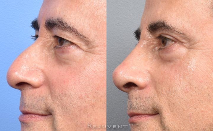 Nose filler before and after 3 sessions