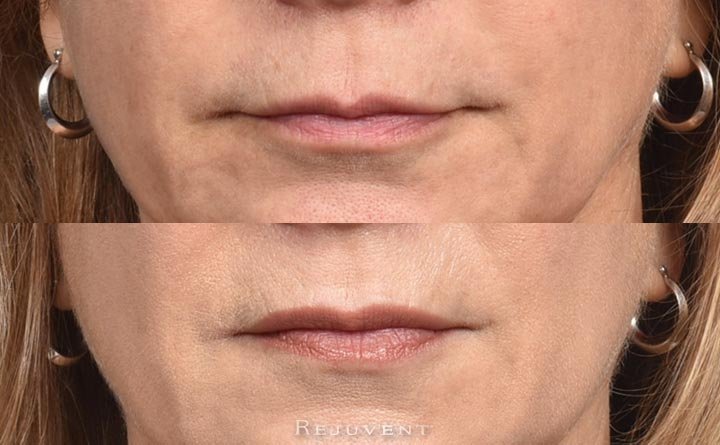 Patient xeomin lip flip volume before and after