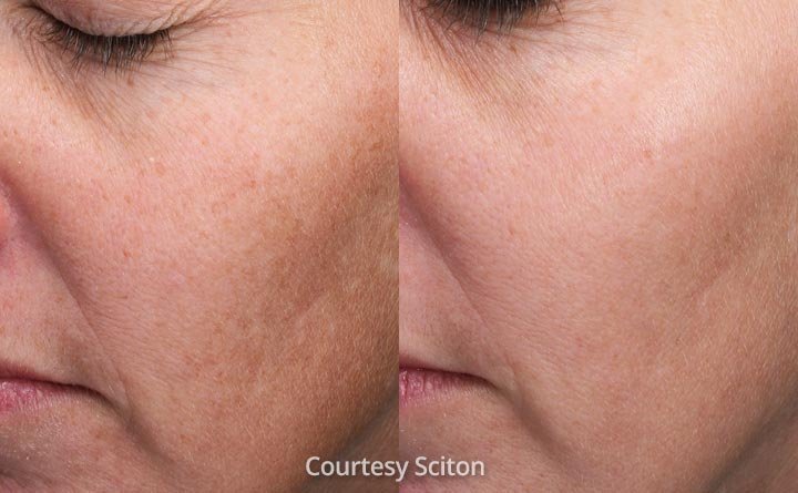 Moxi Laser before and after results showing brighter skin