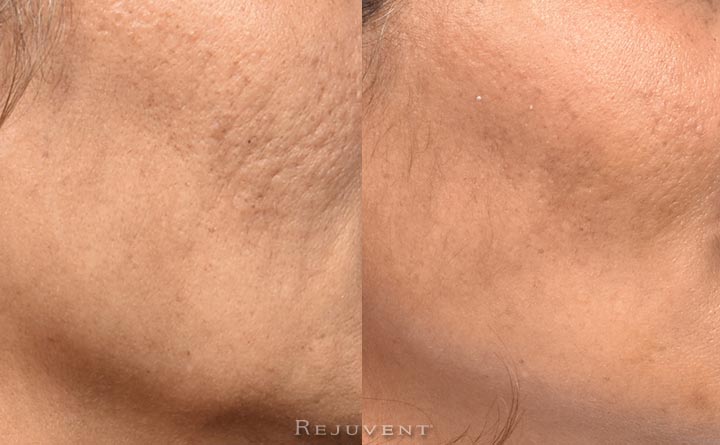 PRF Results achieved at Rejuvent. After image shows much less acne scars and less texture issues.