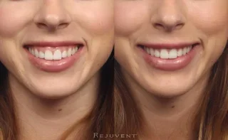 Gummy Smile Corrected with Botox