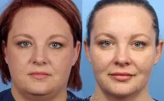 Beautiful Long-term results