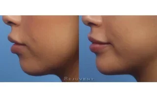 Chin sculpting with volumizing fillers side view